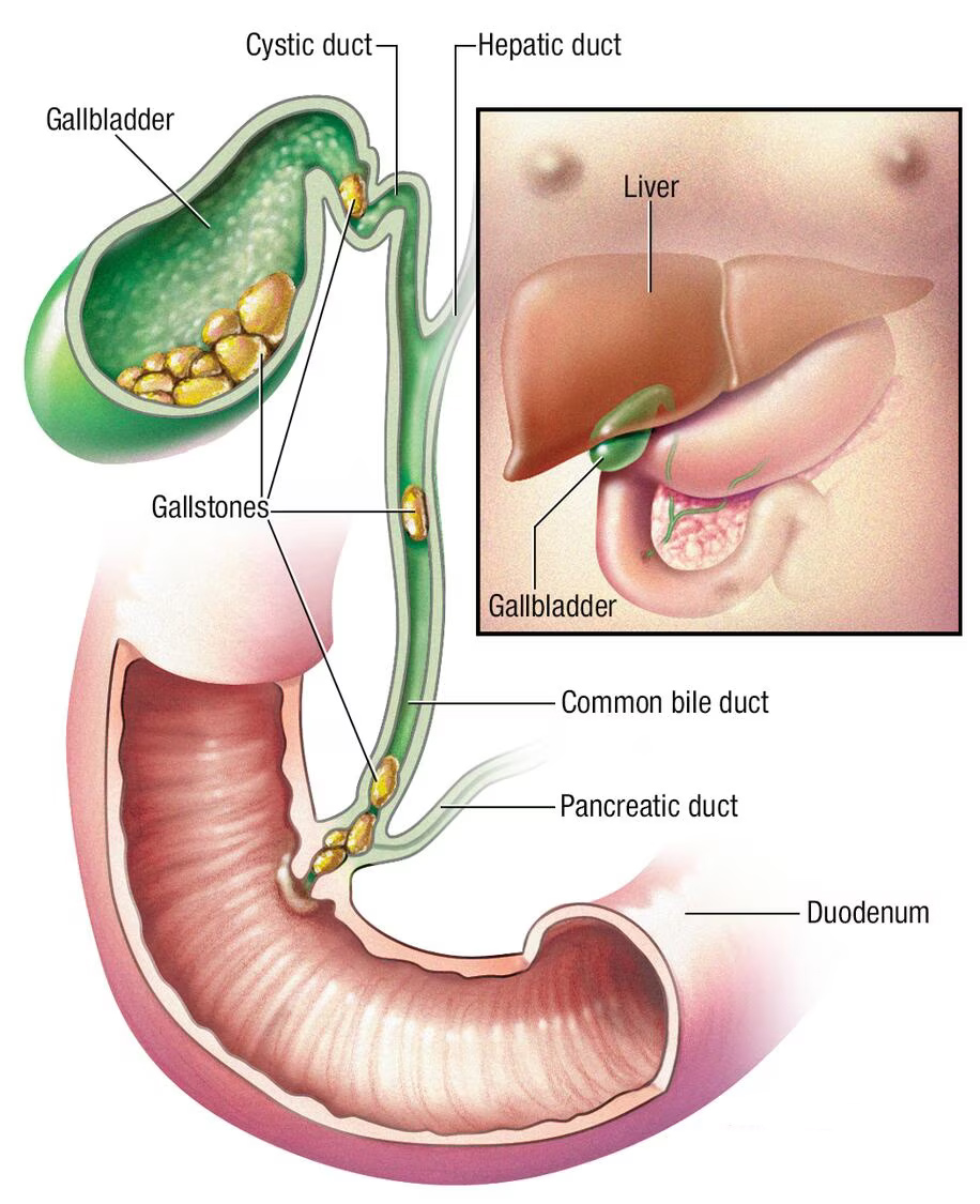 Gallbladder stones