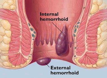 Piles Treatement Advanced Homeopathy Clinic Singapore