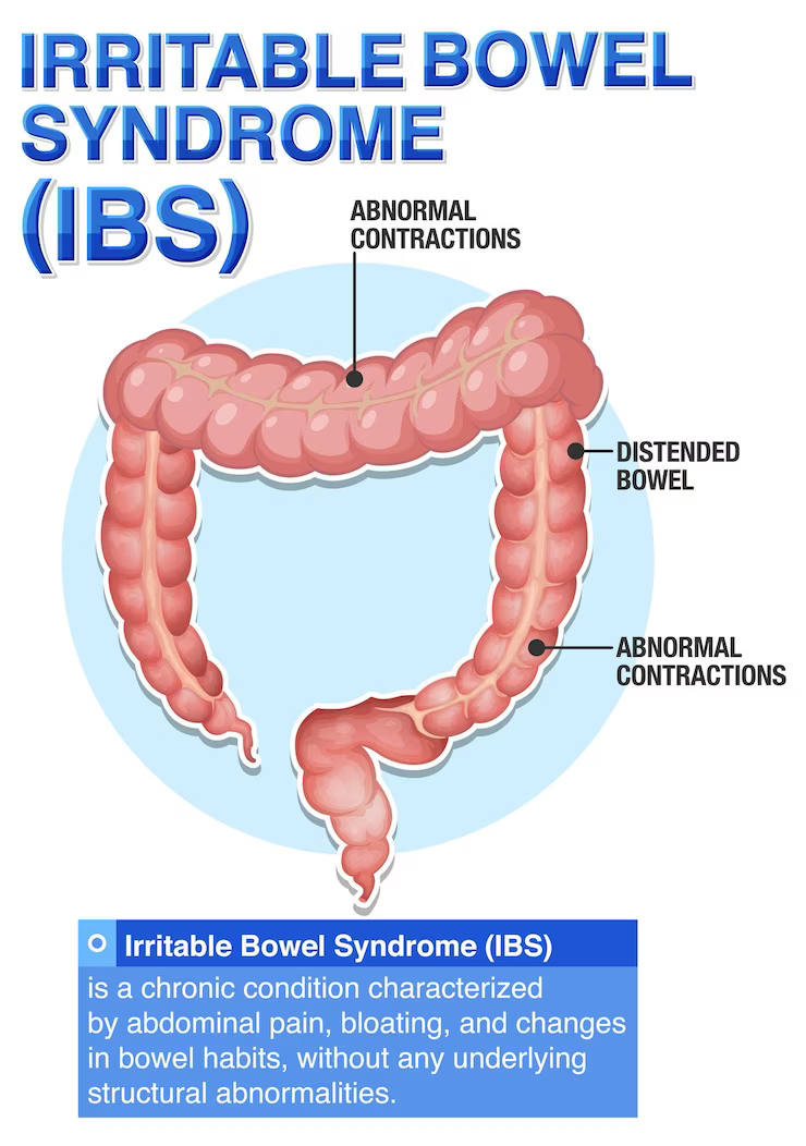 irritable bowel syndrome (IBS)