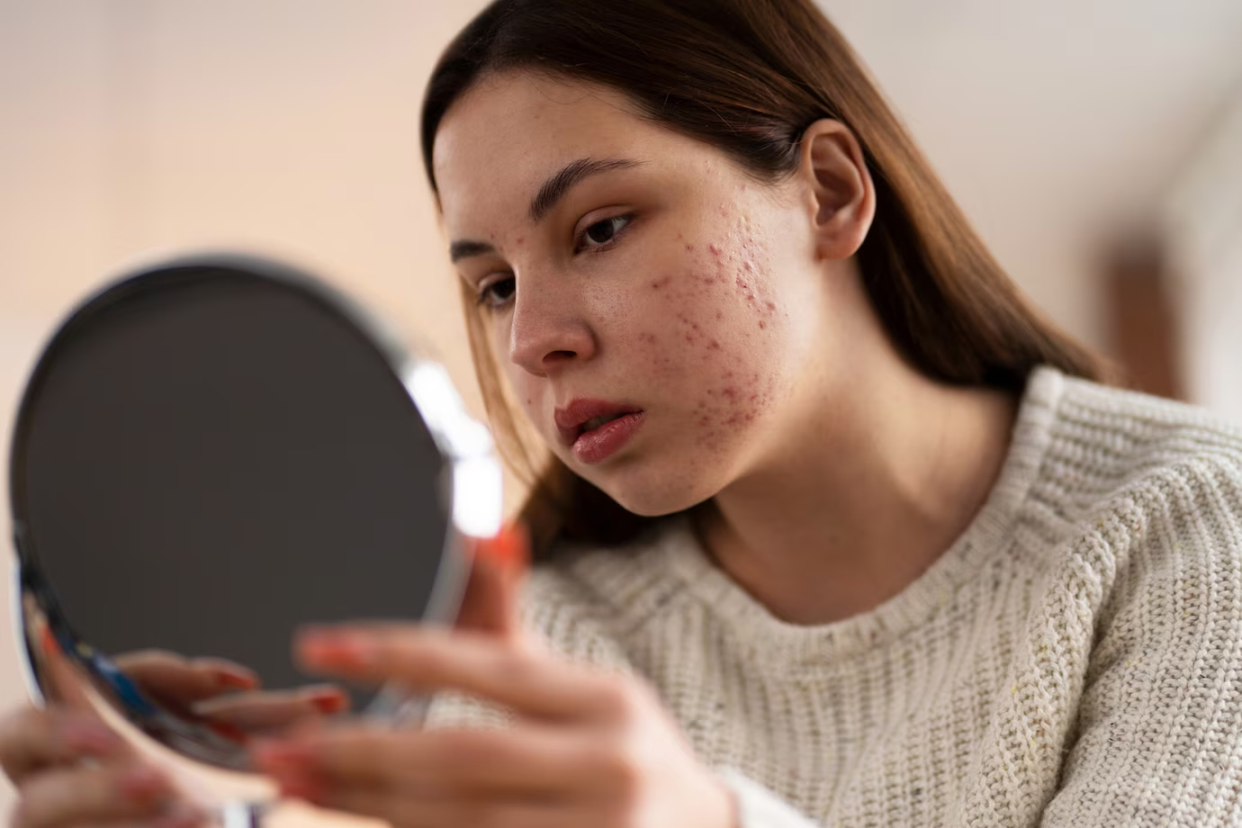 pimples