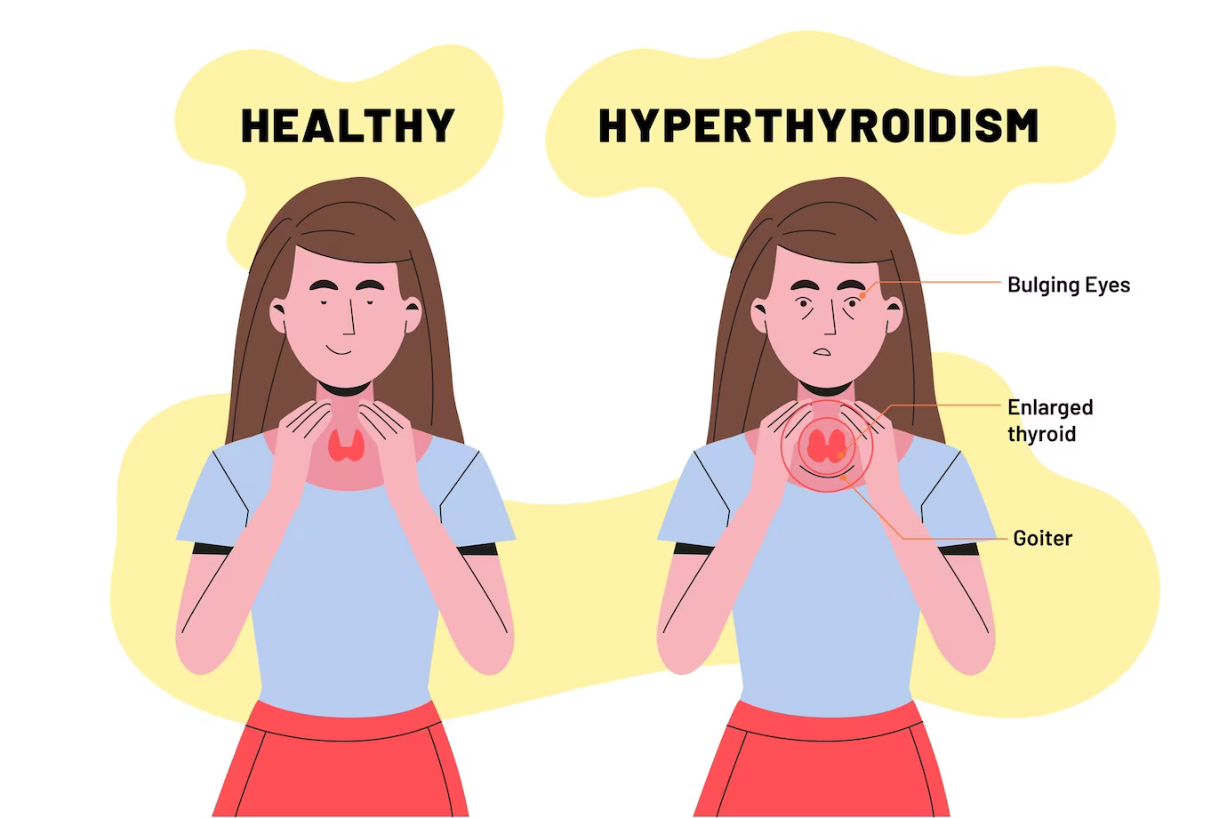 women hyperthrroidism